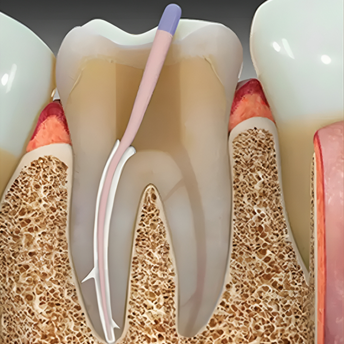 DentAct eZee Pex - Calcium Hydroxide Based Root Canal Sealer
