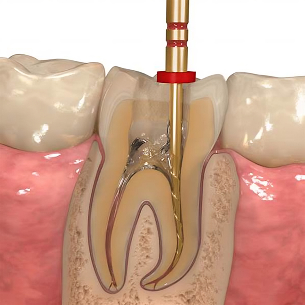 Cerkamed Endo - Solution EDTA Disodium Salt 17%