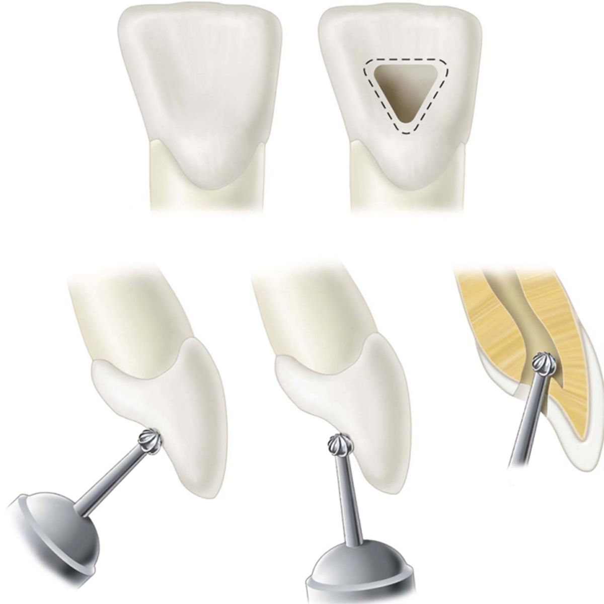 Pivo Cavity Access Endodontic Preparation Airotor Burs Kit (Set Of 9)