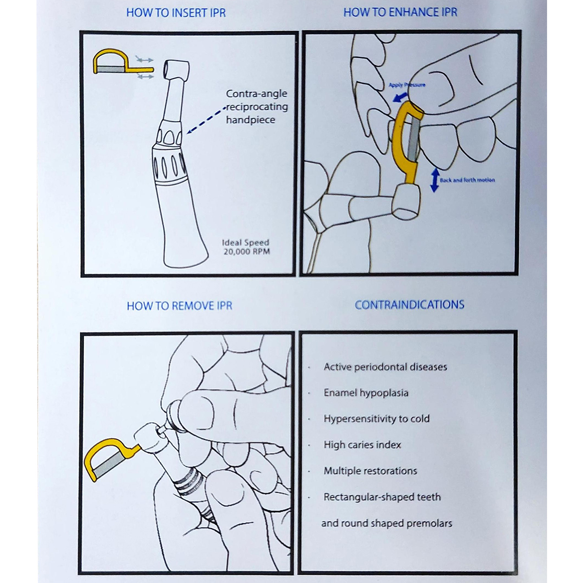 Sawbros Orthodontic IPR Blades set  + Manual Handle Straight