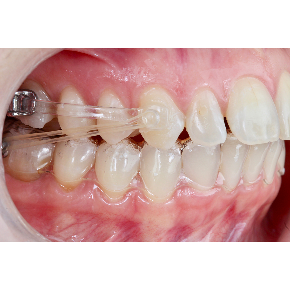 OrthoMetric Iceram Clear Distalizer (2/Pk)