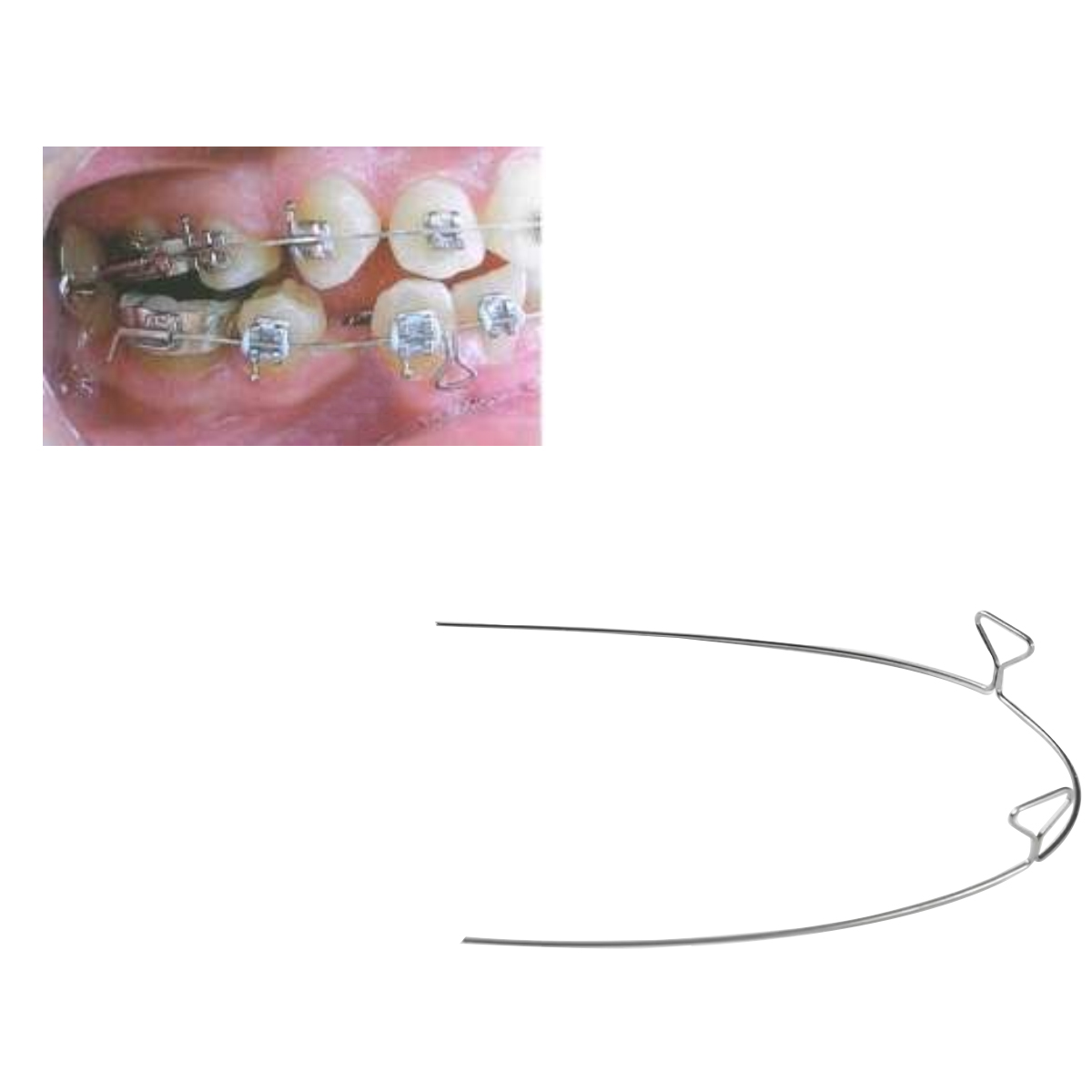 OSL Stainless Steel Keyhole Loop Archwires (Pack Of 10)