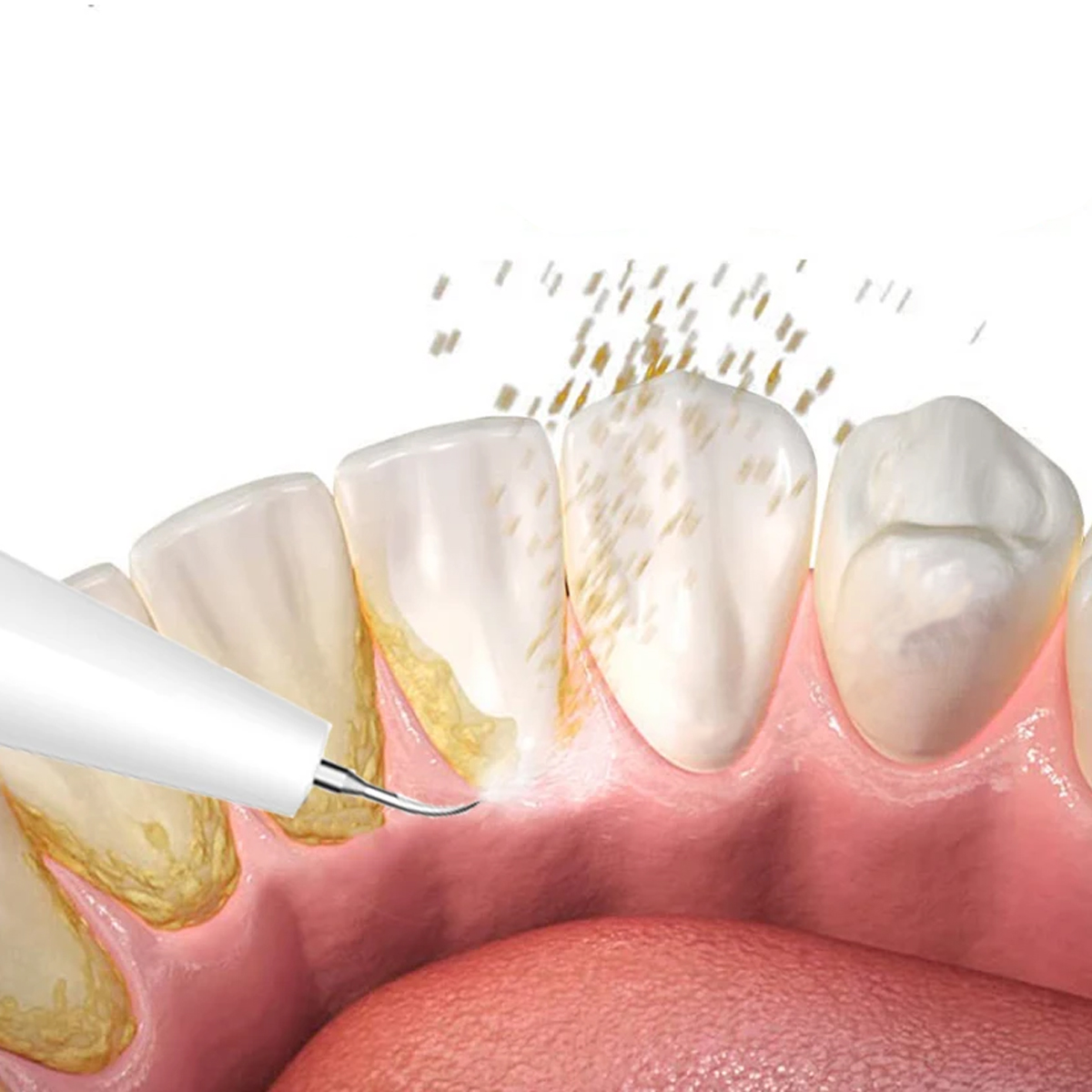 Woodpecker Scaler Tip G6 for UDS & EMS Scalers