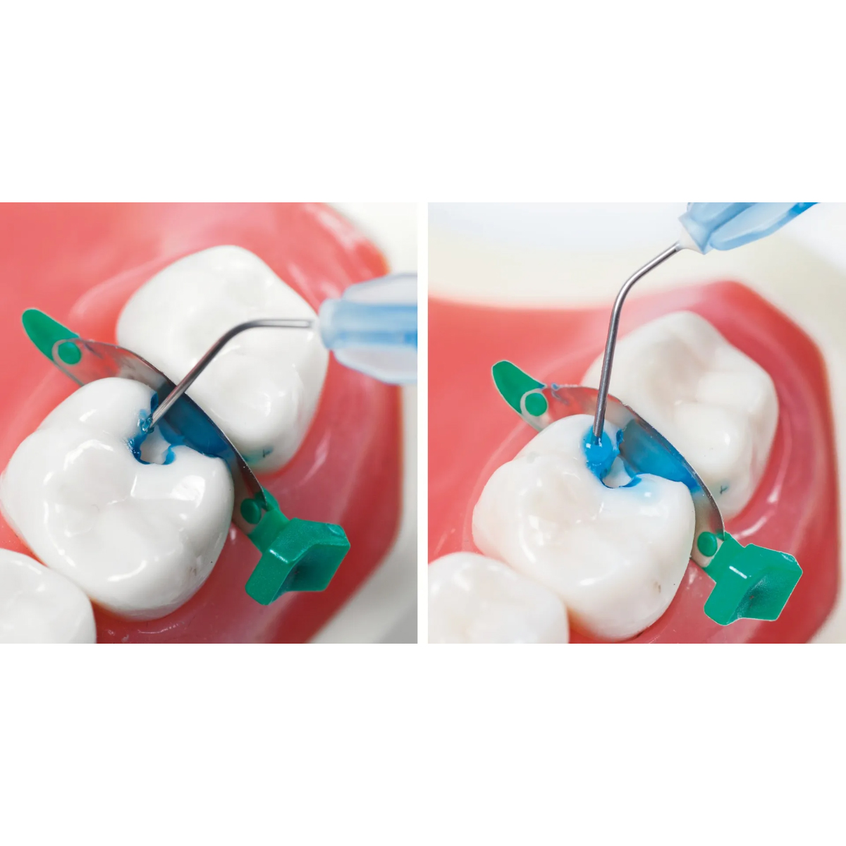 Bisco Select HV Etch 35% High Viscosity Phosphoric Acid Etchant With BAC