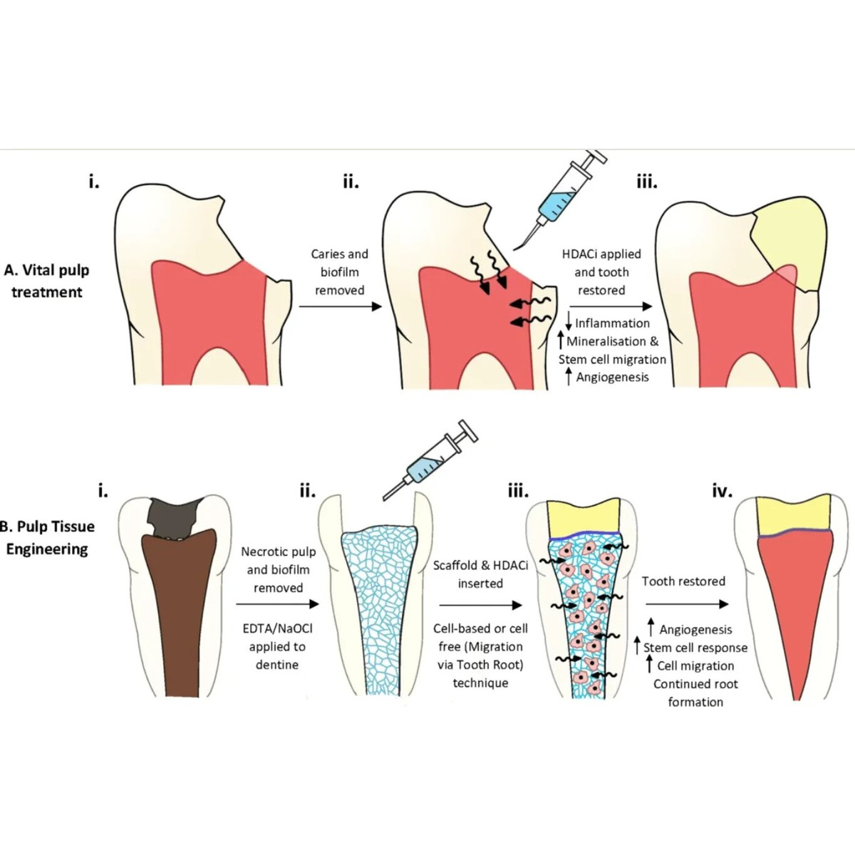 DPI EDTA Gel 17% EDTA Gel with Carbamide Perioxide