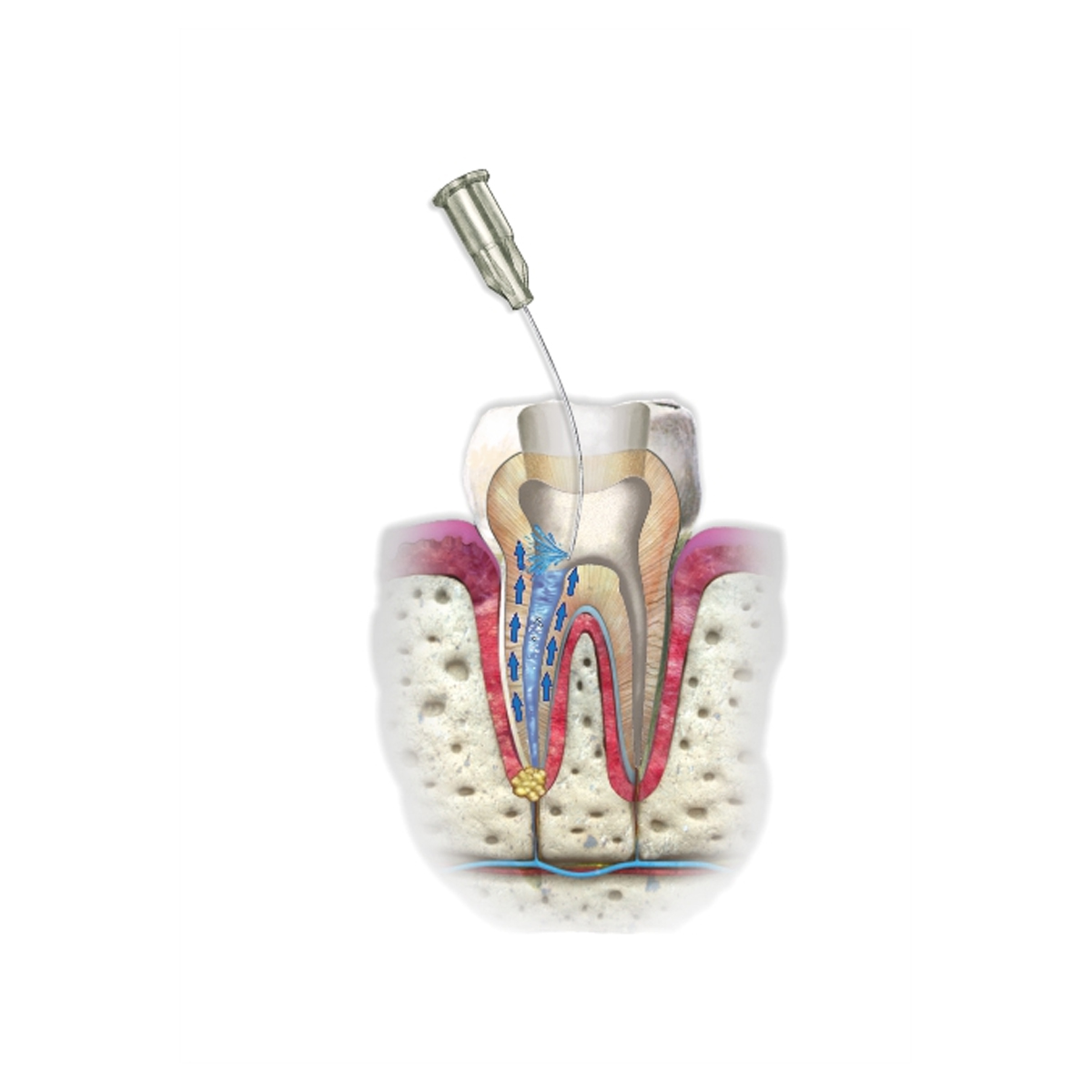 DPI EDTA Gel 17% EDTA Gel with Carbamide Perioxide
