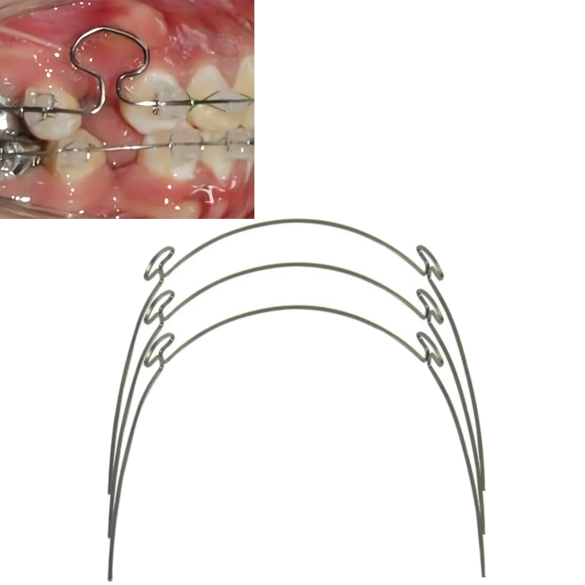 OSL Beta 3 Titanium CNA Mushroom Loop Archwires (Pack Of 5)