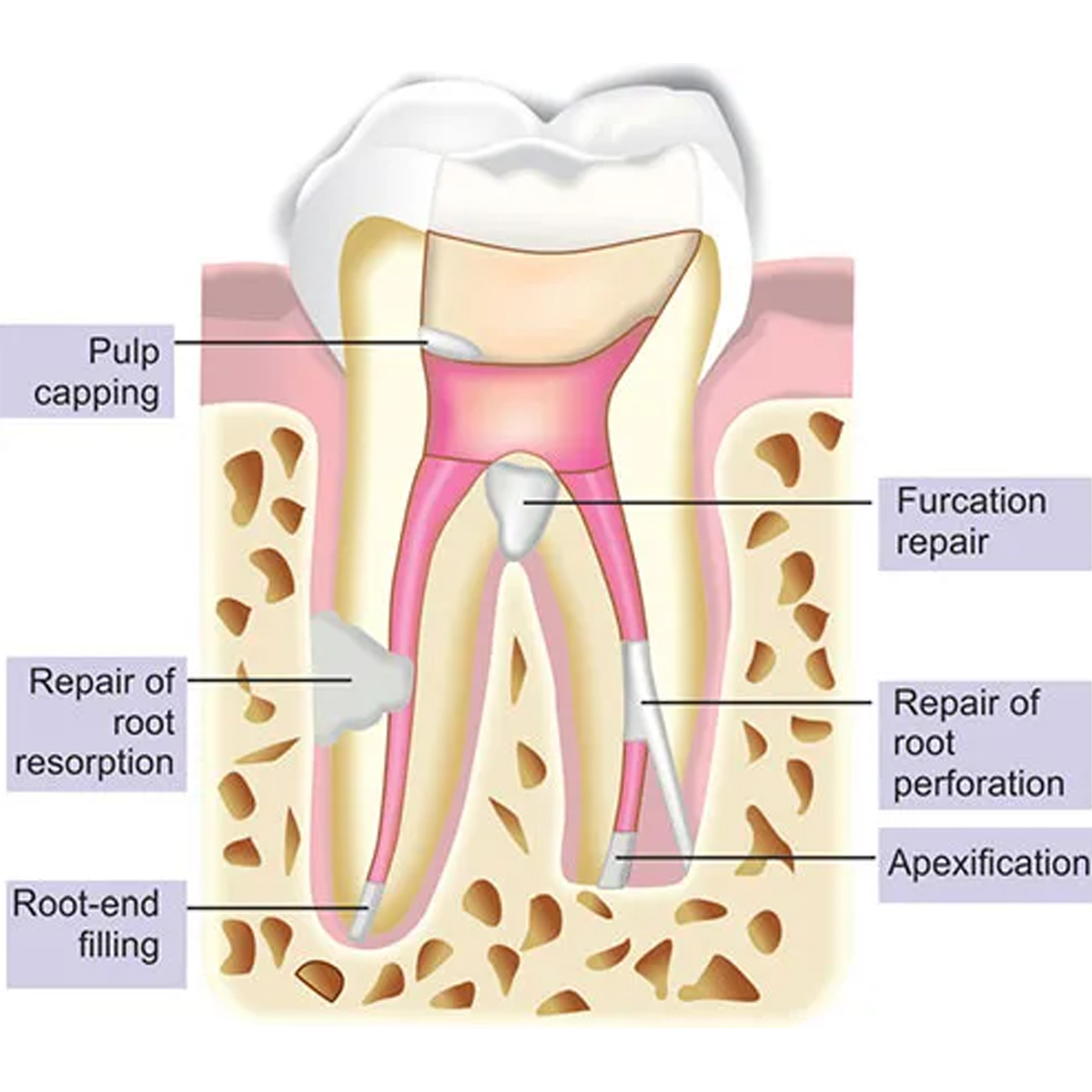 DPI MTA Mineral Trioxide Aggregate Reparative Cement