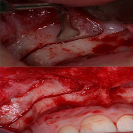 Woodpecker Piezo Bone Surgery Tip - US1