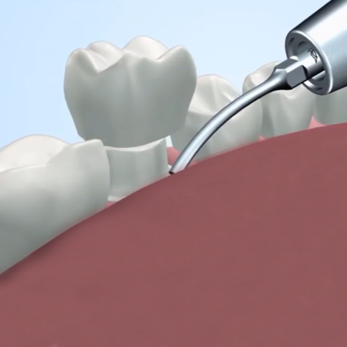 Woodpecker Scaler Tip G7 for UDS & EMS Scalers