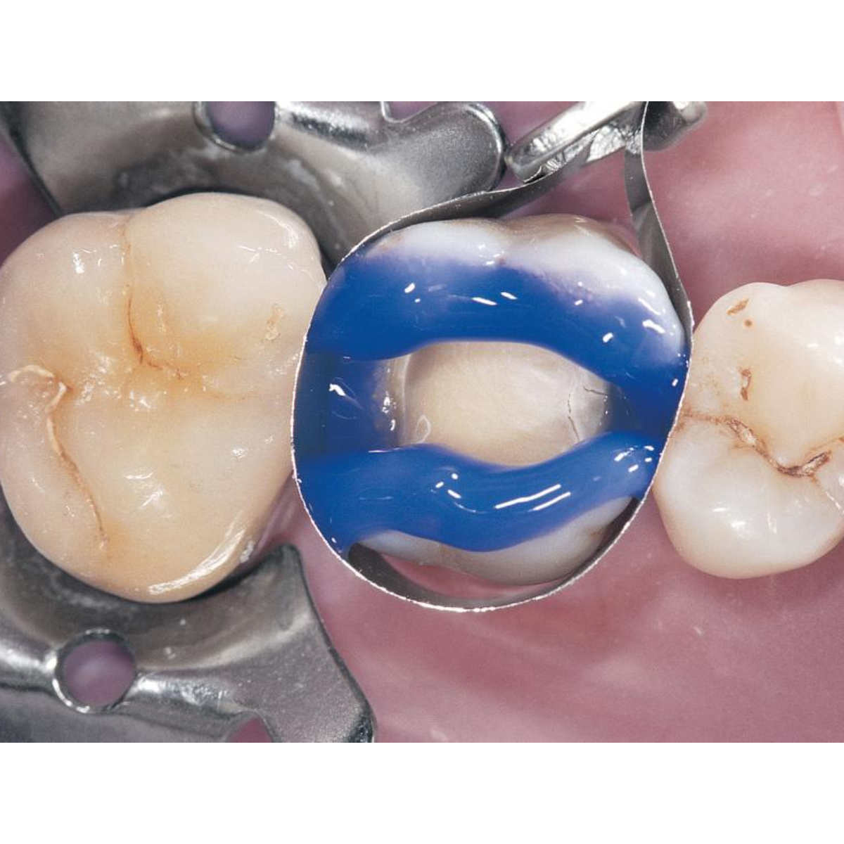 Bisco Select HV Etch 35% High Viscosity Phosphoric Acid Etchant With BAC