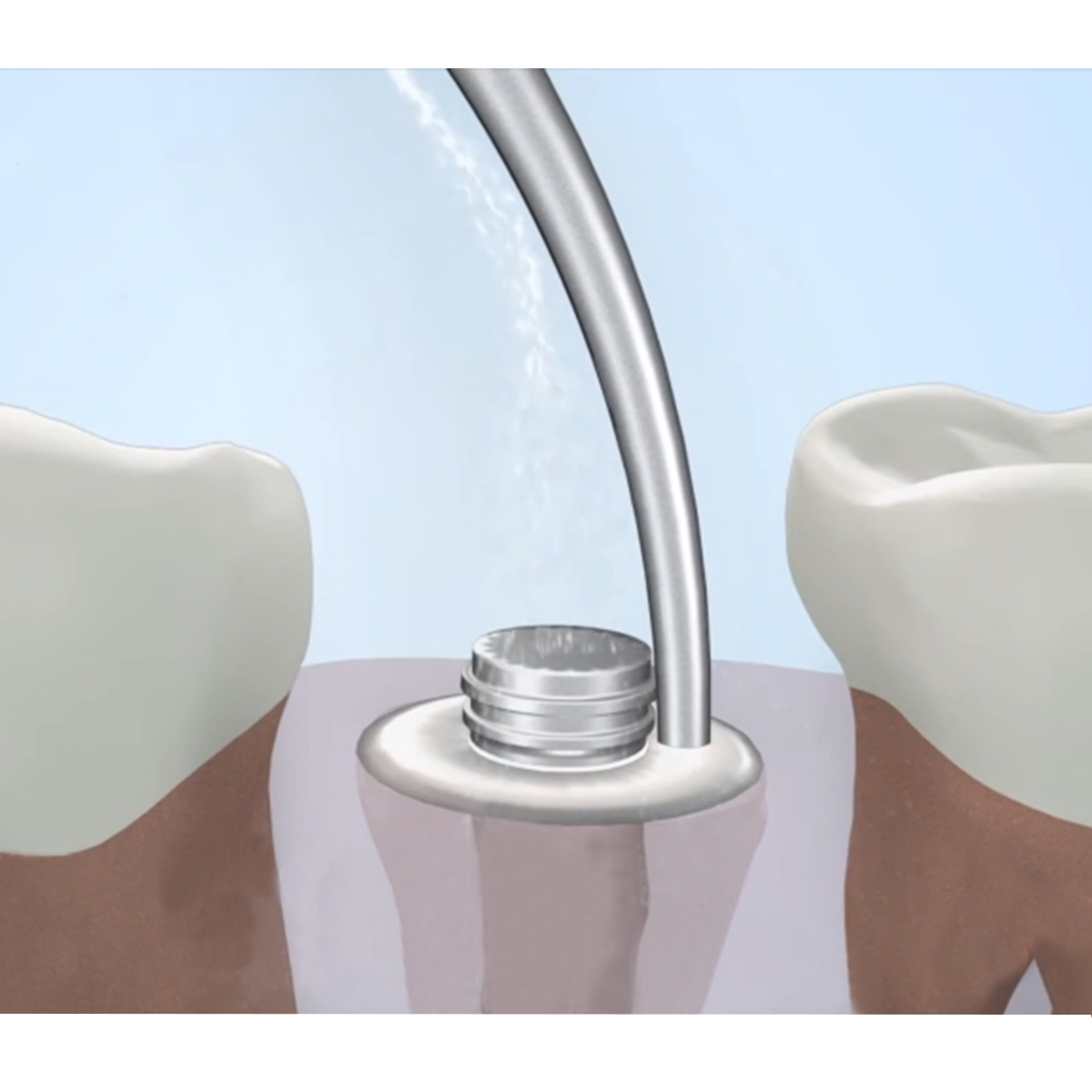 Woodpecker Scaler Tip G8 for UDS & EMS Scalers