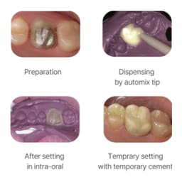 Nexobio Trantemp Bis - Acrylic Composite Temporization Material (Shade A2) - 4