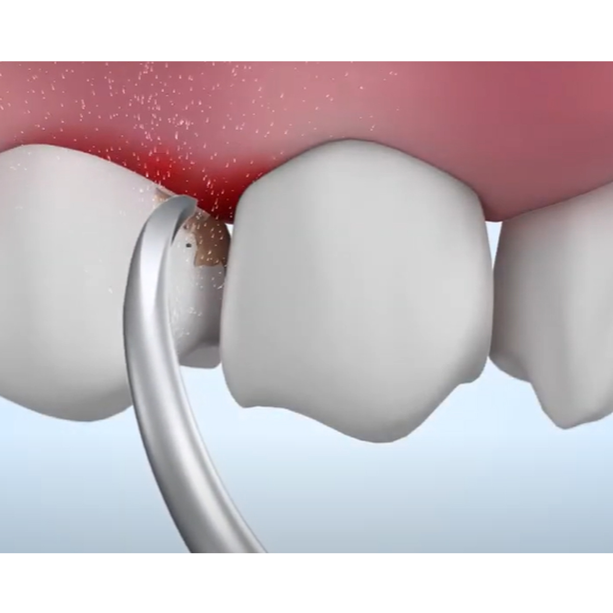 Woodpecker Scaler Tip G9 for UDS & EMS Scalers