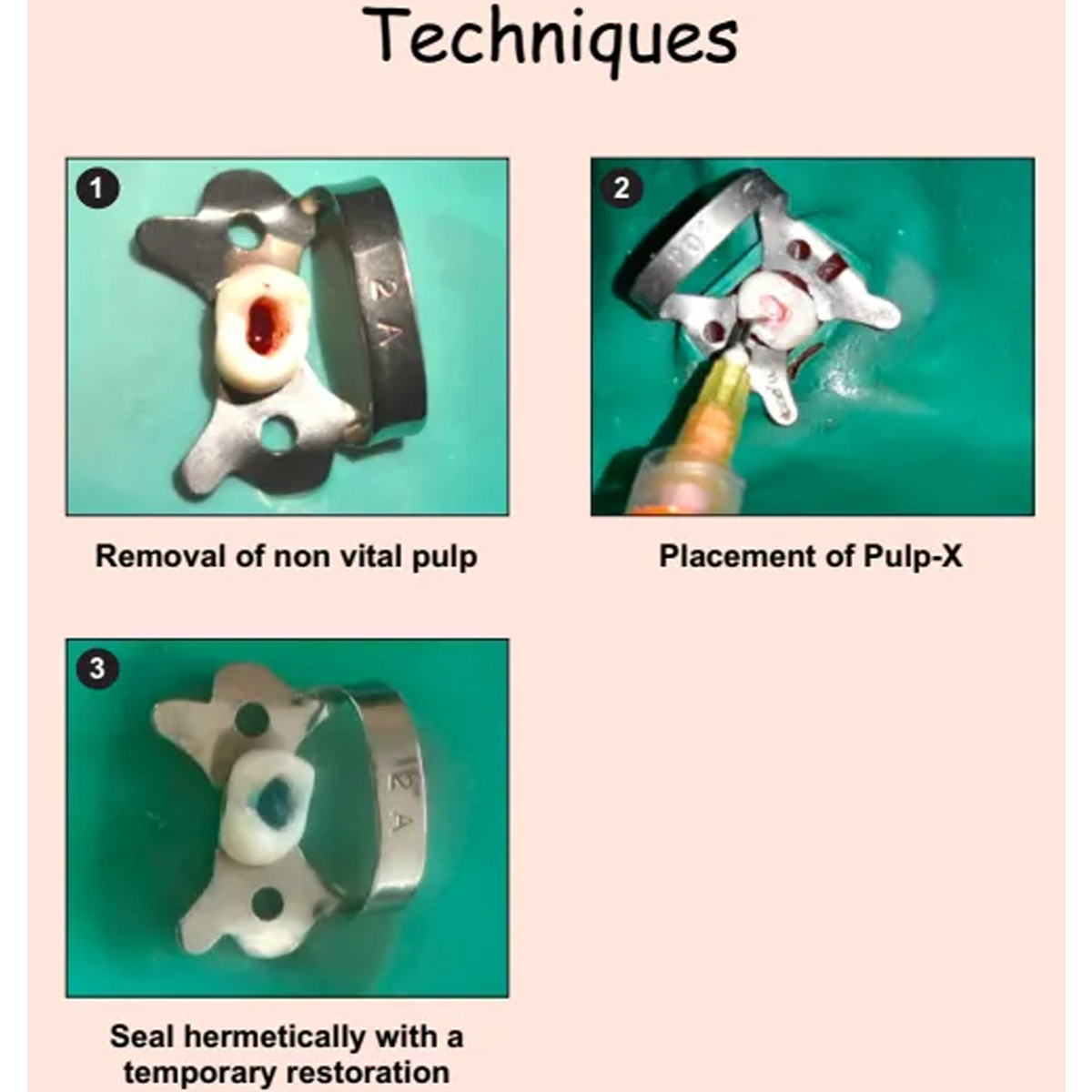 DPI Pulpdev Gel Pulp Devitalizer Gell