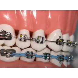 OrthoMetric Flexy NiTi Orthodontic Springs - 4