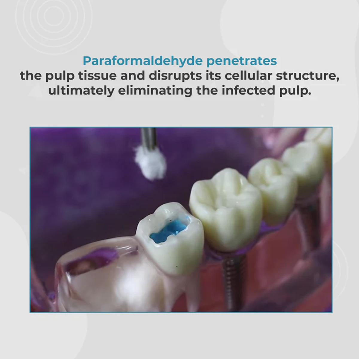 DPI Pulpdev Paste Pulp Devitalizer Paste
