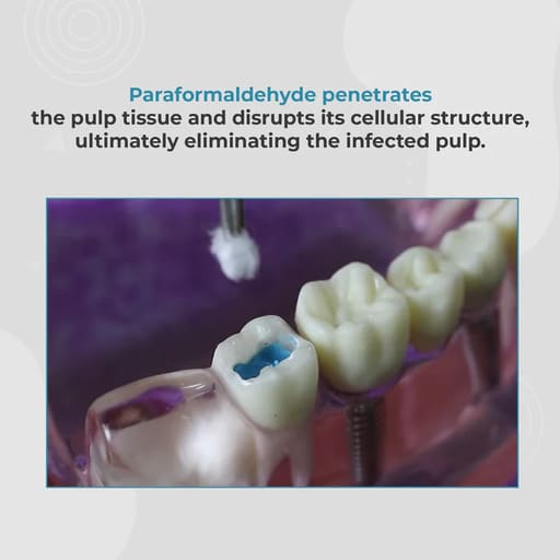 DPI Pulpdev Paste Pulp Devitalizer Paste (FP013)