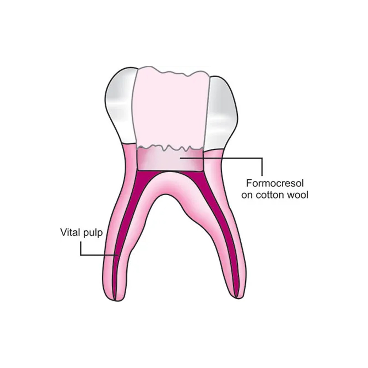 DPI F-Cresol Formocresol