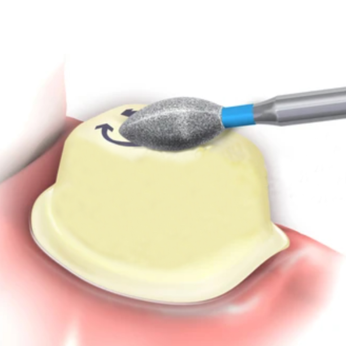 Pivo Flame Ogival End Contra-angle Diamond Burs CA - FO- (Pack Of 5)