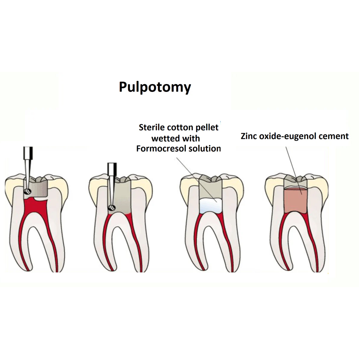 DPI F-Cresol Formocresol