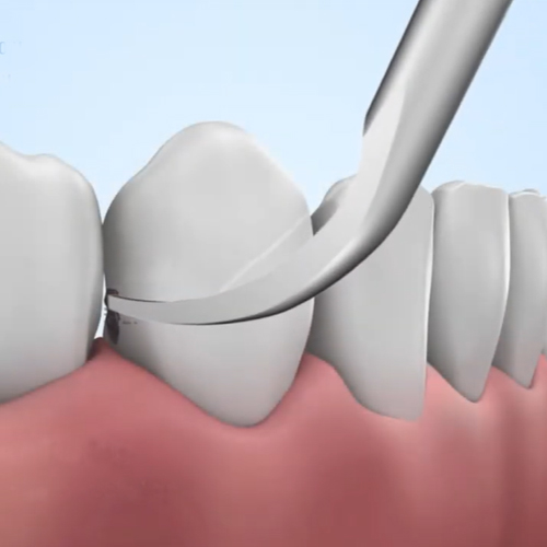 Woodpecker Scaler Tip P1 for UDS & EMS Scalers