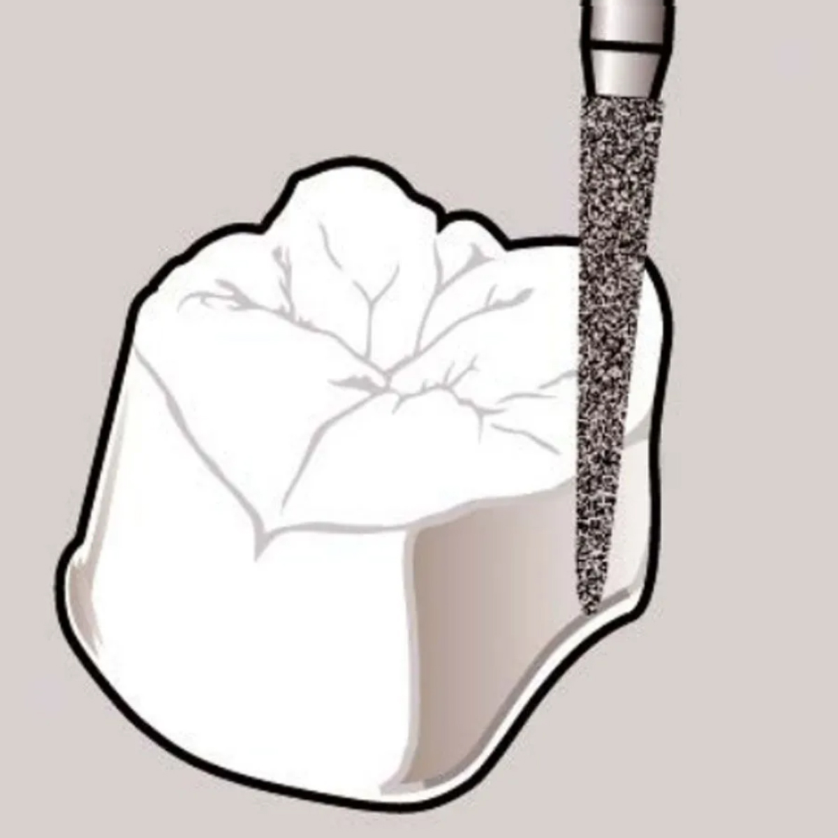 Pivo Taper Conical End Contra-angle Diamond Bur CA - TC-11 (Pack Of 5)