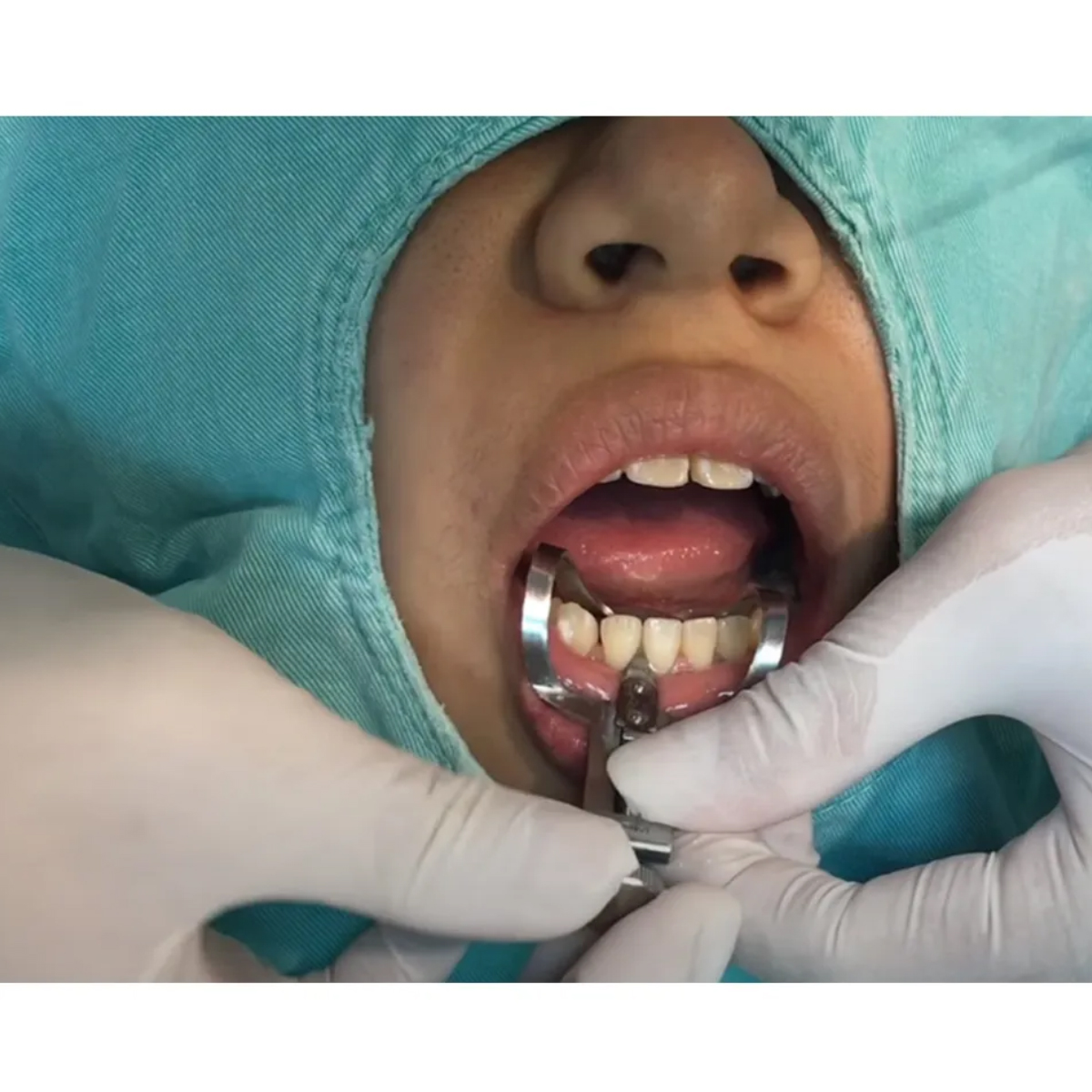 GDC Tooth Separator - (TSE)