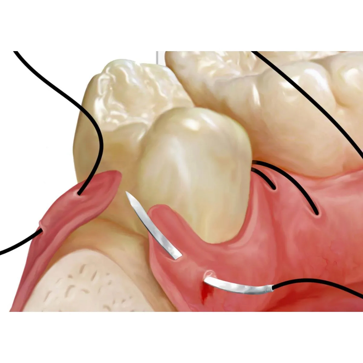 All Med Silk Braided 3-0 3/8 Circle Reverse Cutting Suture (Pack Of 12) - 26mm