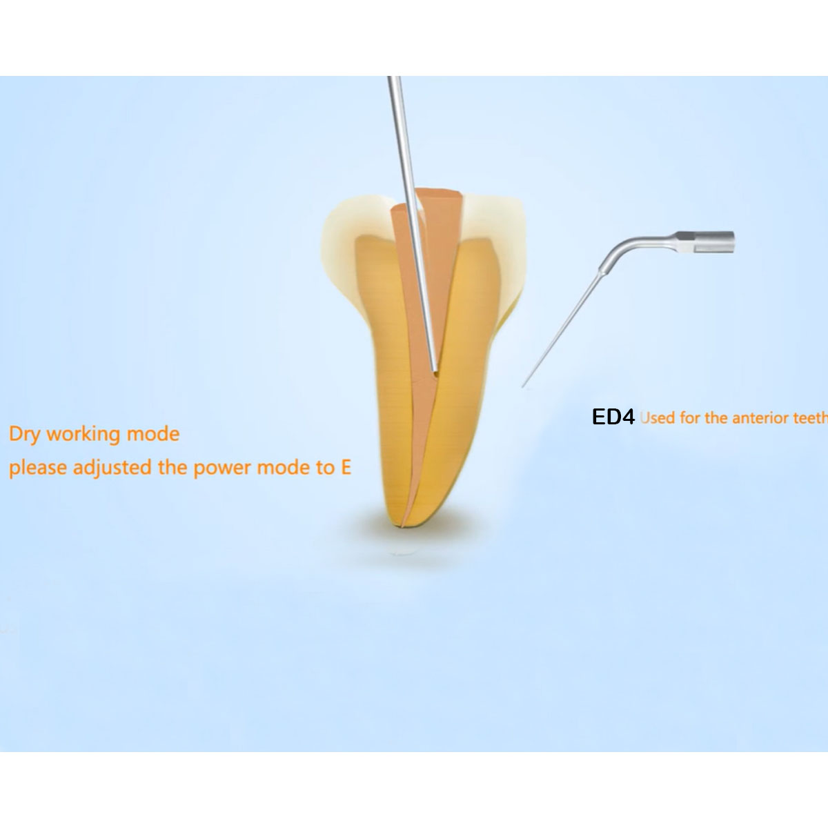 Woodpecker Scaler Tip ED4 for DTE & Satelec Scalers