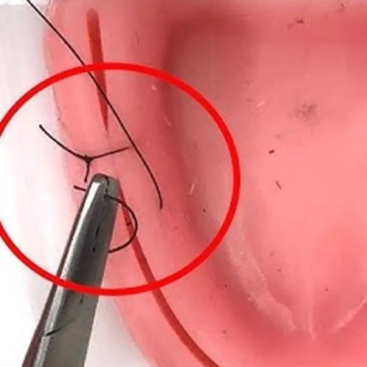 Ethicon Mersilk #3-0 Black Braided Suture1 - 90Cm(Nw5003) Pack Of 12