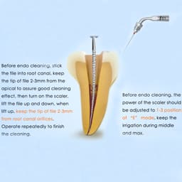 Woodpecker Scaler Tip E1 for UDS & EMS Scalers       - 8