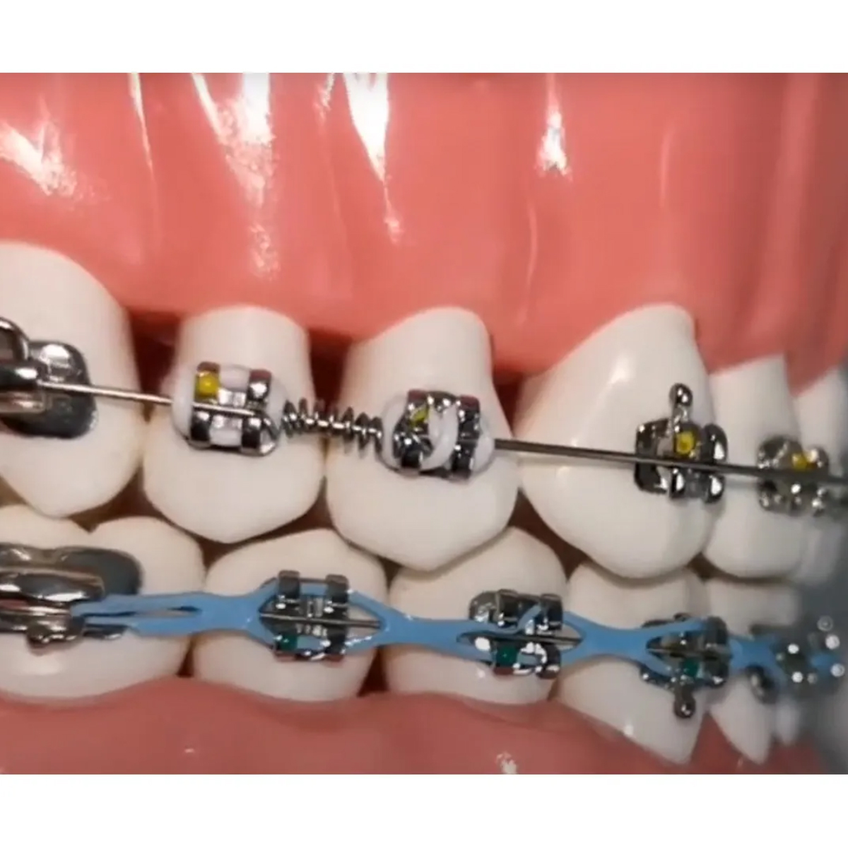 OrthoMetric Flexy NiTi Orthodontic Spring Open (Ø0.75mm X 178mm) - 35.20.0010