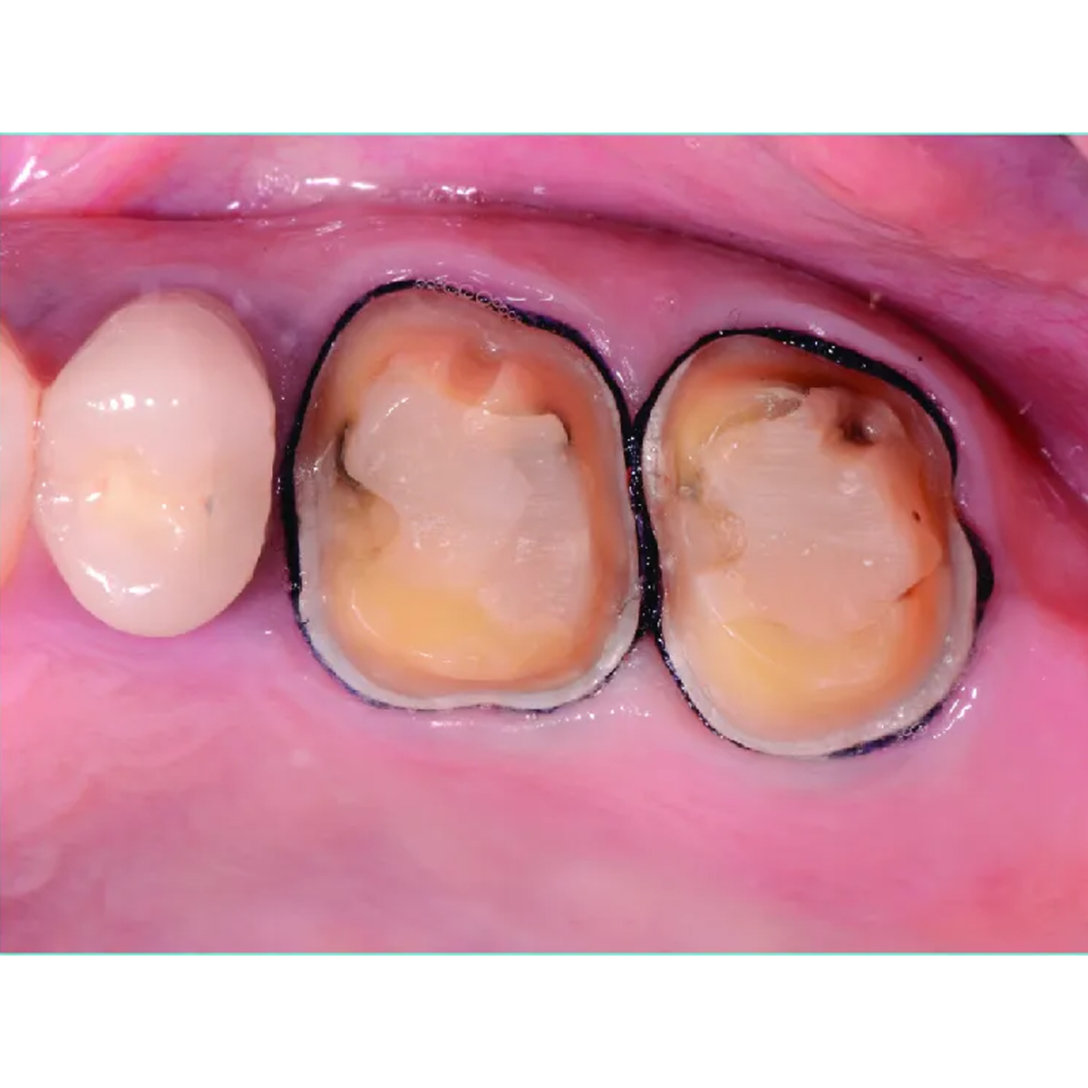 DPI Hemostatic Gel Gingival Retraction Gel