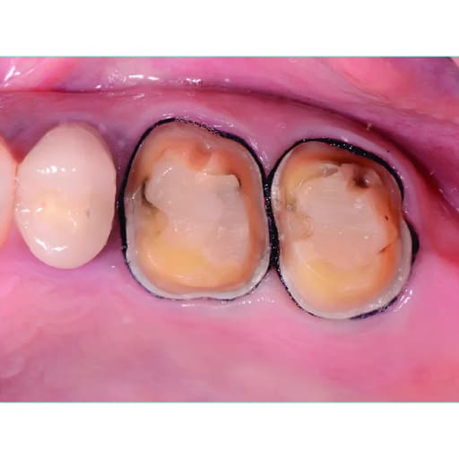 DPI Hemostatic Gel Gingival Retraction Gel (FH001)