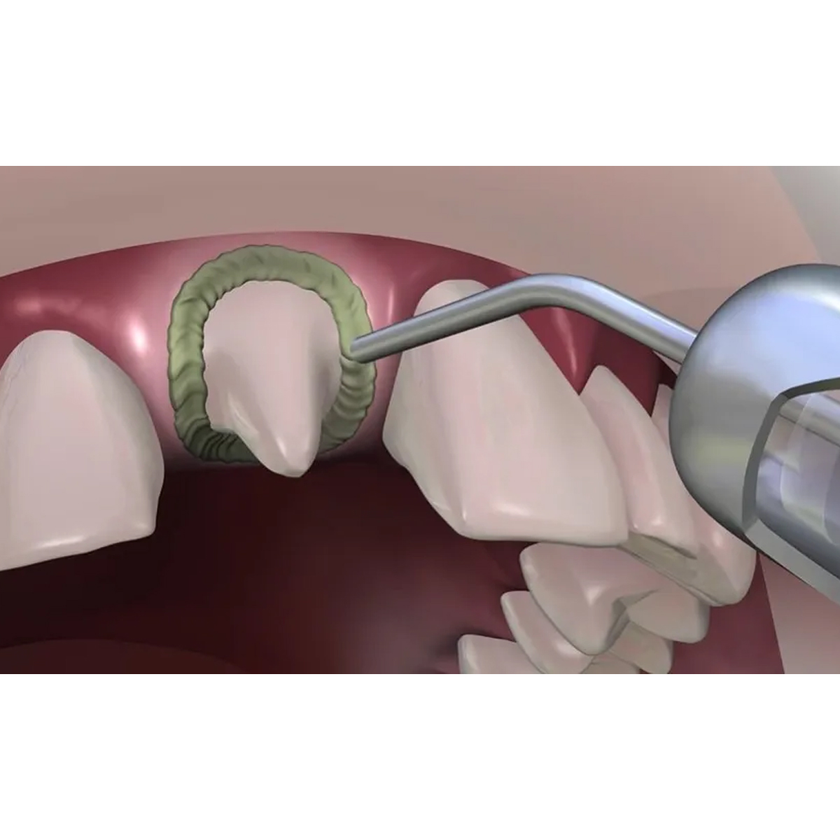 DPI Hemostatic Gel Gingival Retraction Gel