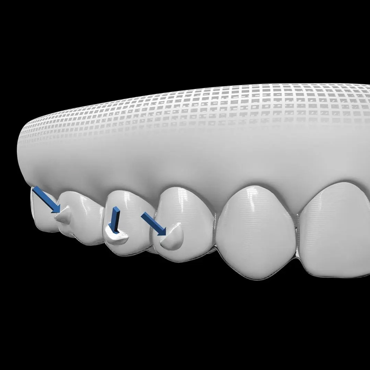 DentAct Aligner Fix Orthdontic Adhesive For Aligner Attachments