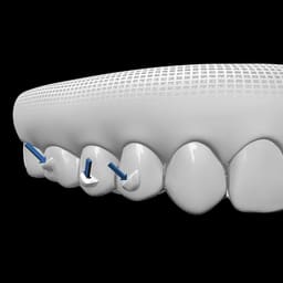 DentAct Aligner Fix Orthdontic Adhesive For Aligner Attachments - 4