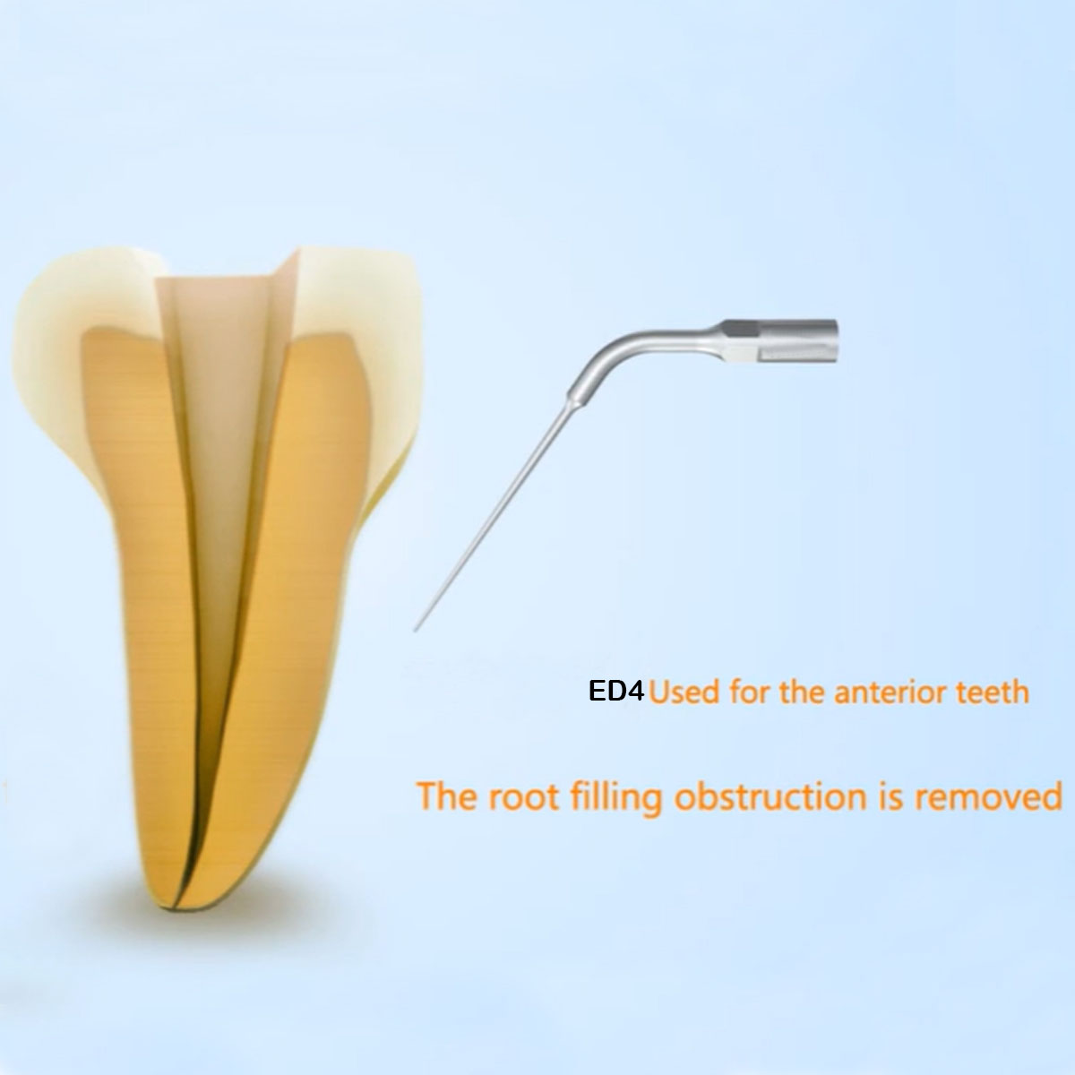 Woodpecker Scaler Tip ED4 for DTE & Satelec Scalers