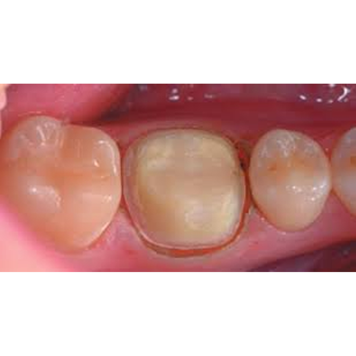 DPI Hemostatic Solution Gingival Retraction Solution
