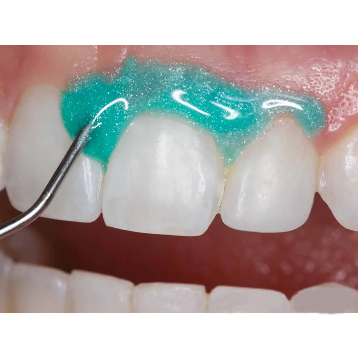 Prime Dental Gingisafe Light Cure Gingival Barrier Kit