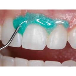 Prime Dental Gingisafe Light Cure Gingival Barrier Kit - 2