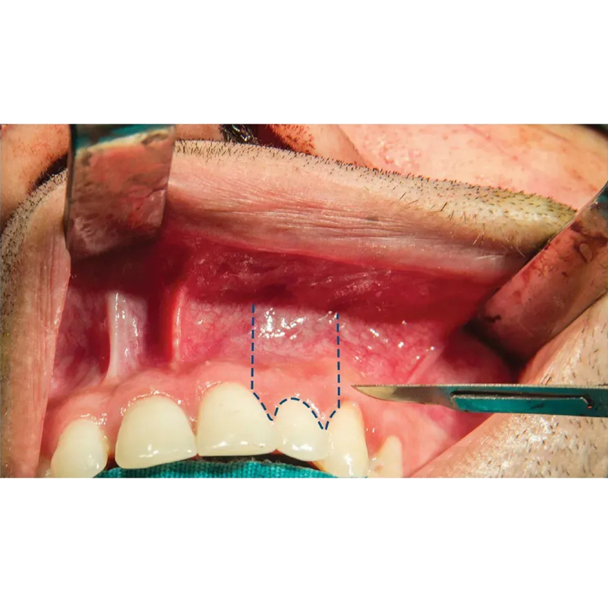 Waldent Scalpel Handle 12.5 cm #3 - 10-130-03 (9/116)