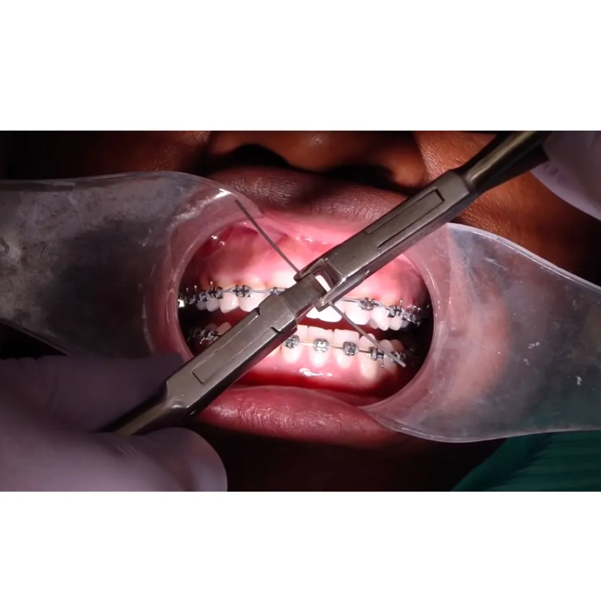 GDC Orthodontics Wire Bending Pliers Torquing Plier # Female (3000/18)