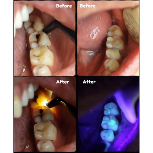HN Dental Lumi Scan