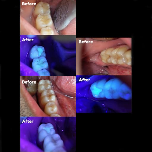 HN Dental Lumi Scan