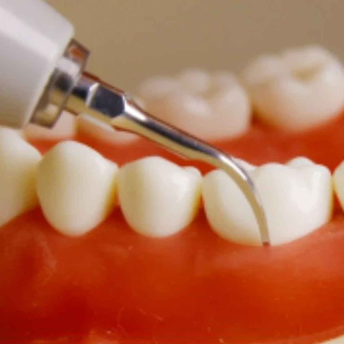 Woodpecker Scaler Tip G2 for UDS & EMS Scalers