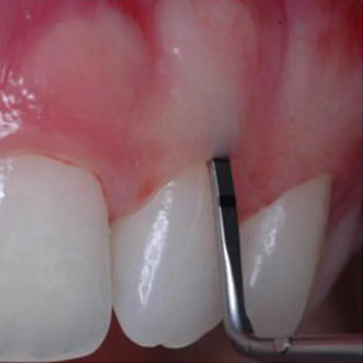 Waldent Moon Probe With Round Solid Handle (9/106)