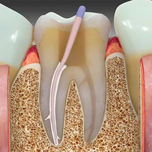 DPI Apexfill Resin Based Radiopaque Root Canal sealer (FA021)