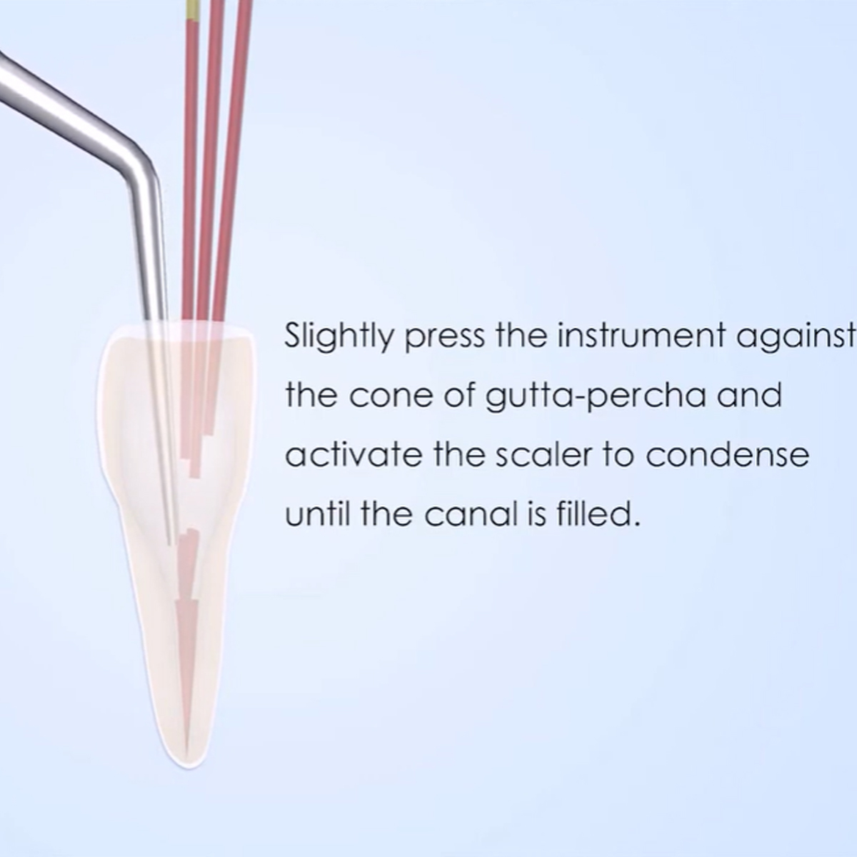 Woodpecker Scaler Tip ED3 for DTE & Satelec Scalers